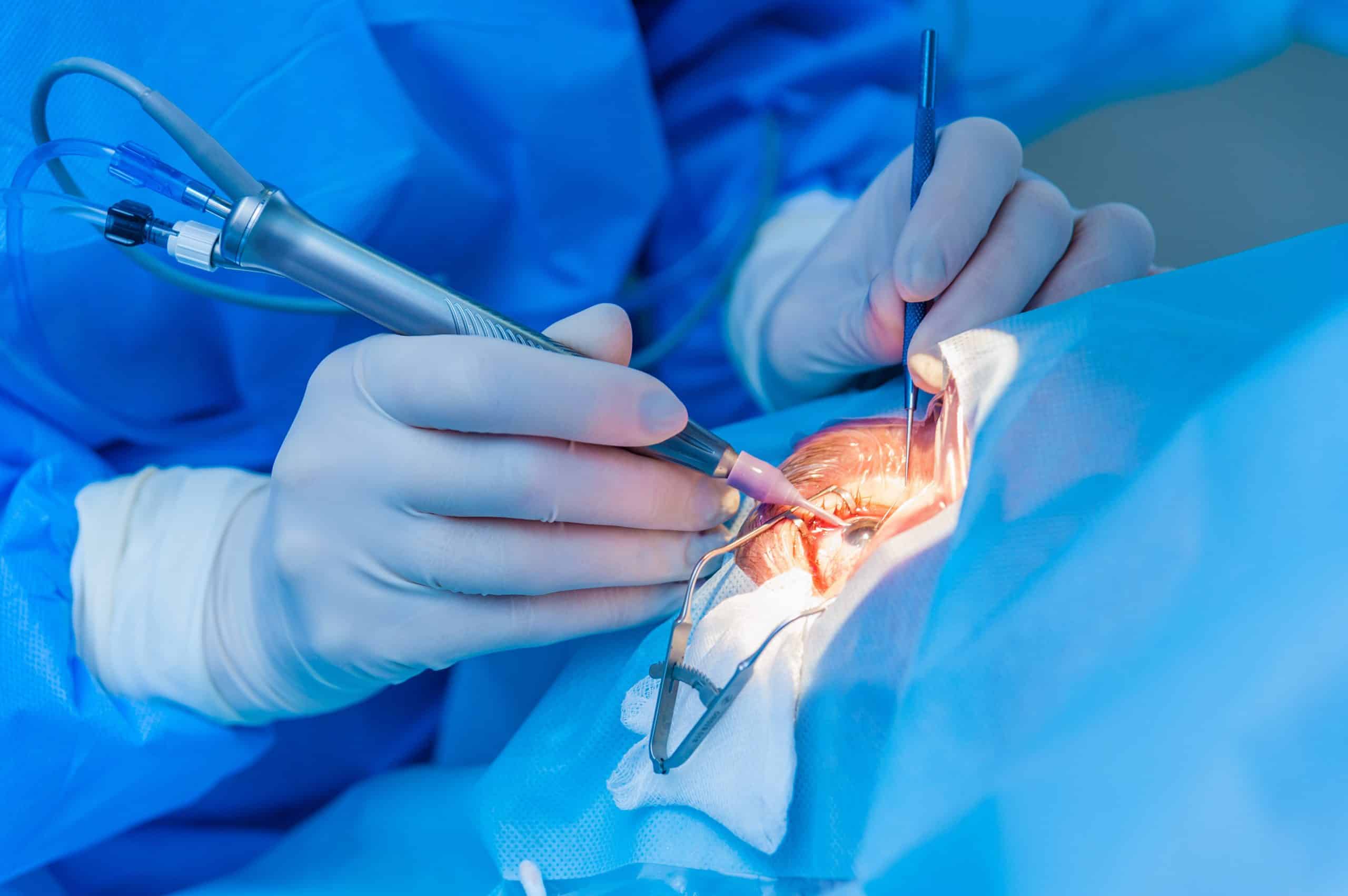 cataract surgery collaborative care