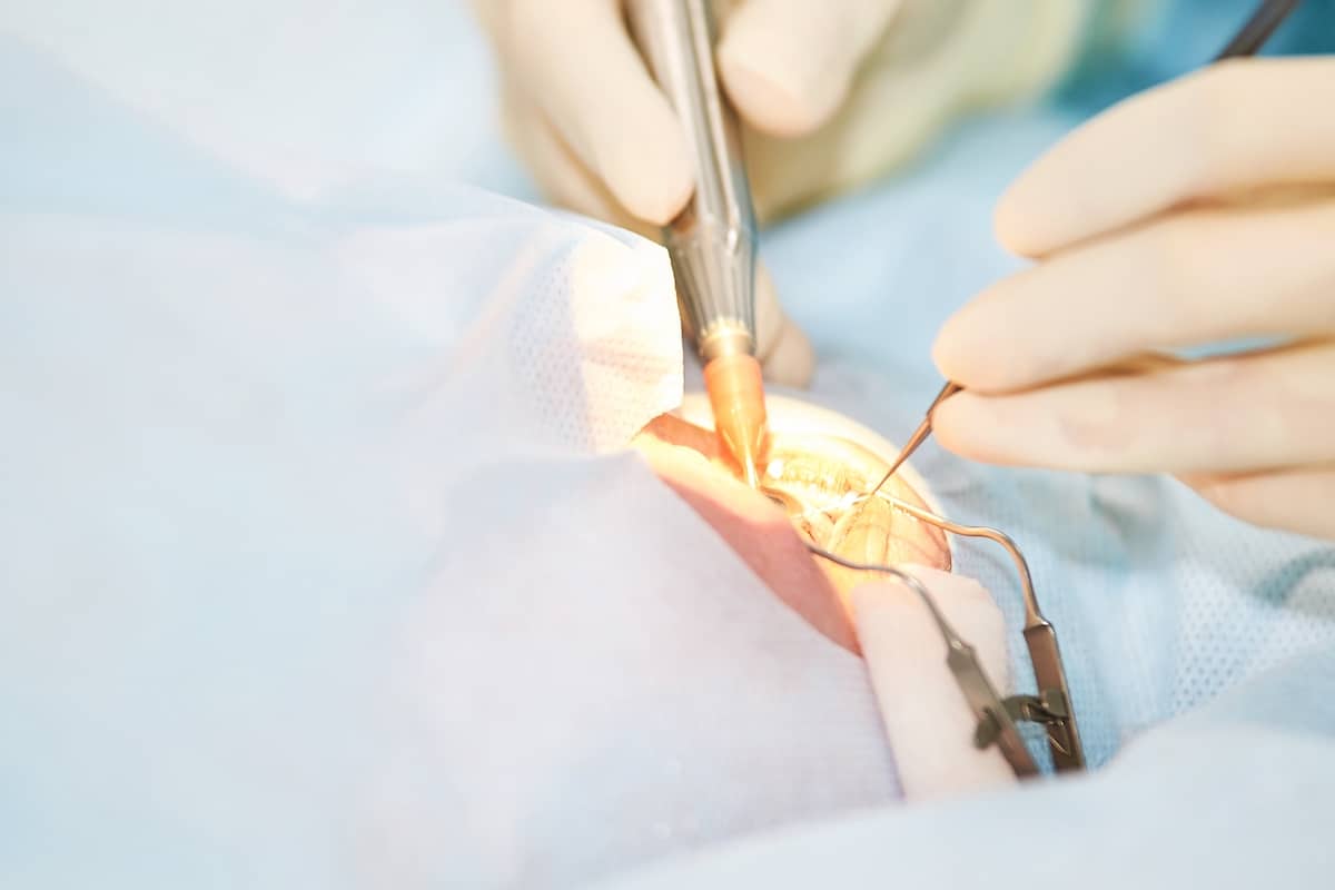 Cataracts are the most common elective surgery diagnosis in Australia.