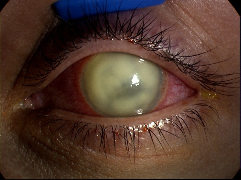 Resistant organisms can lead to ocular infection that can irreversibly damage eye structures.