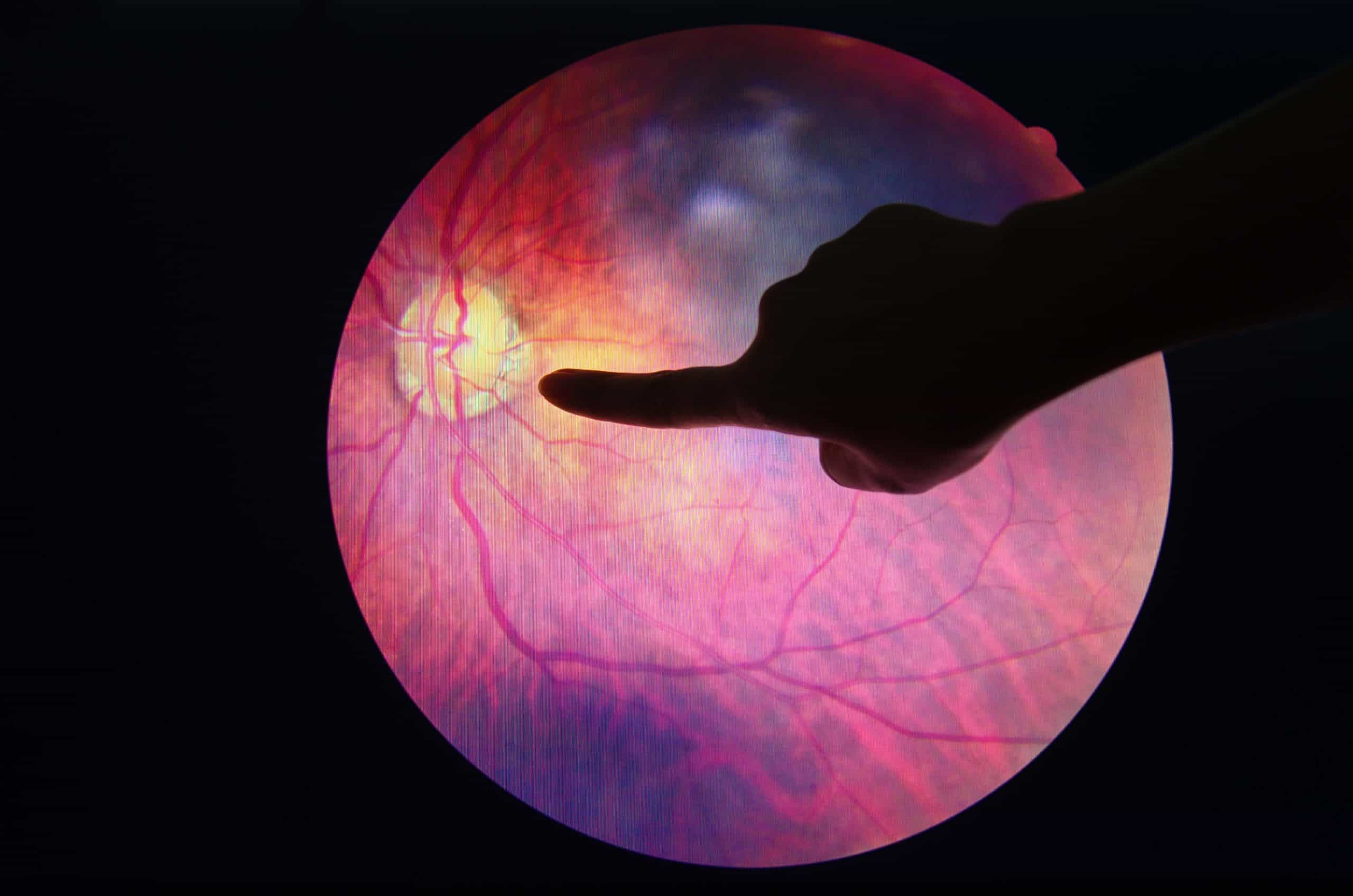 Researchers expected early treatment to prevent progression of diabetic retinopathy.