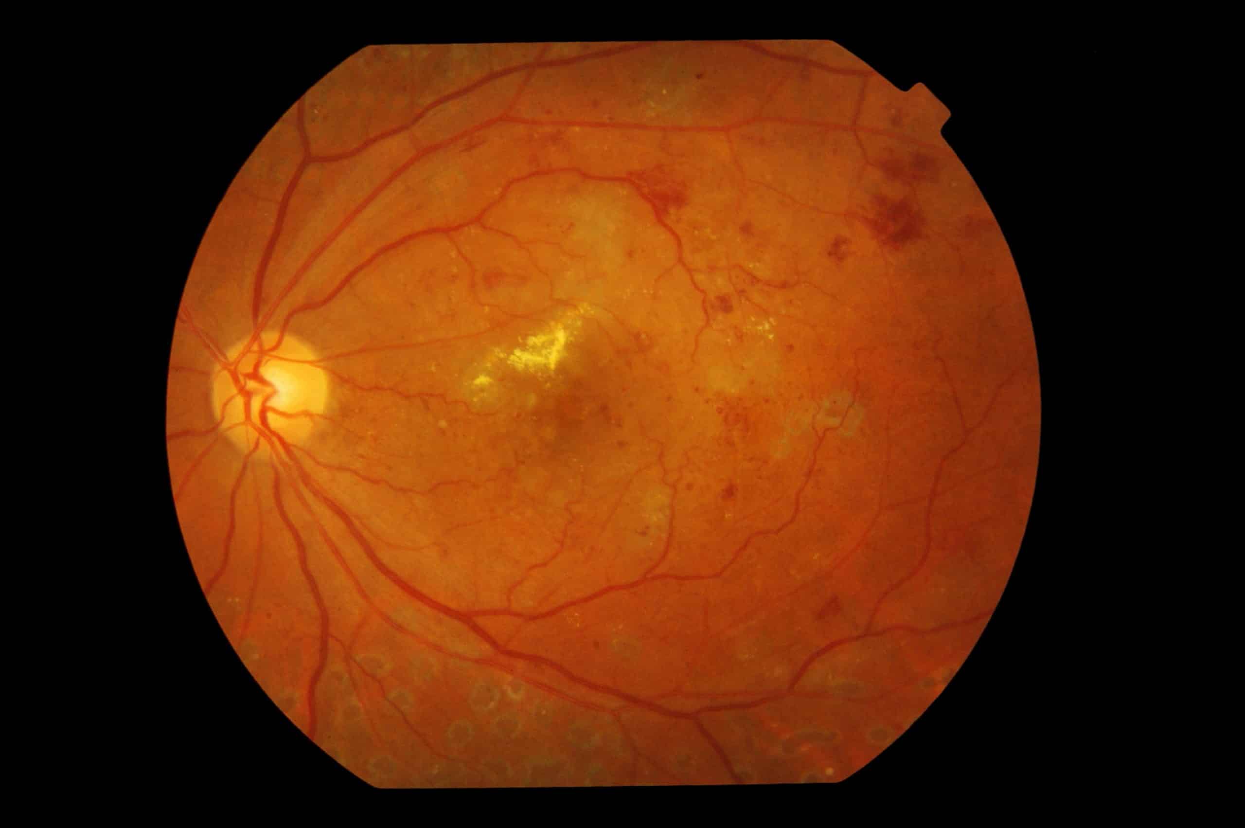 Between 300,000 and 400,000 Australians have diabetic retinopathy.