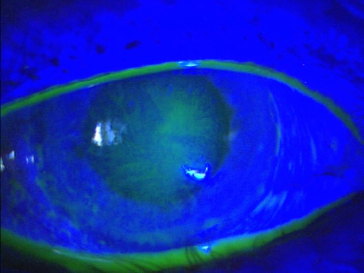 Dry eye disease prevalence ranges from 5% to 50% globally.