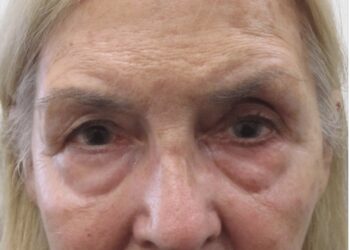 Figure 1. Patient showing significant skin pigmentation due to chronic prostaglandin analogue use in the left eye. There is mild enophthalmos with deepening of the sulcus superiorly.