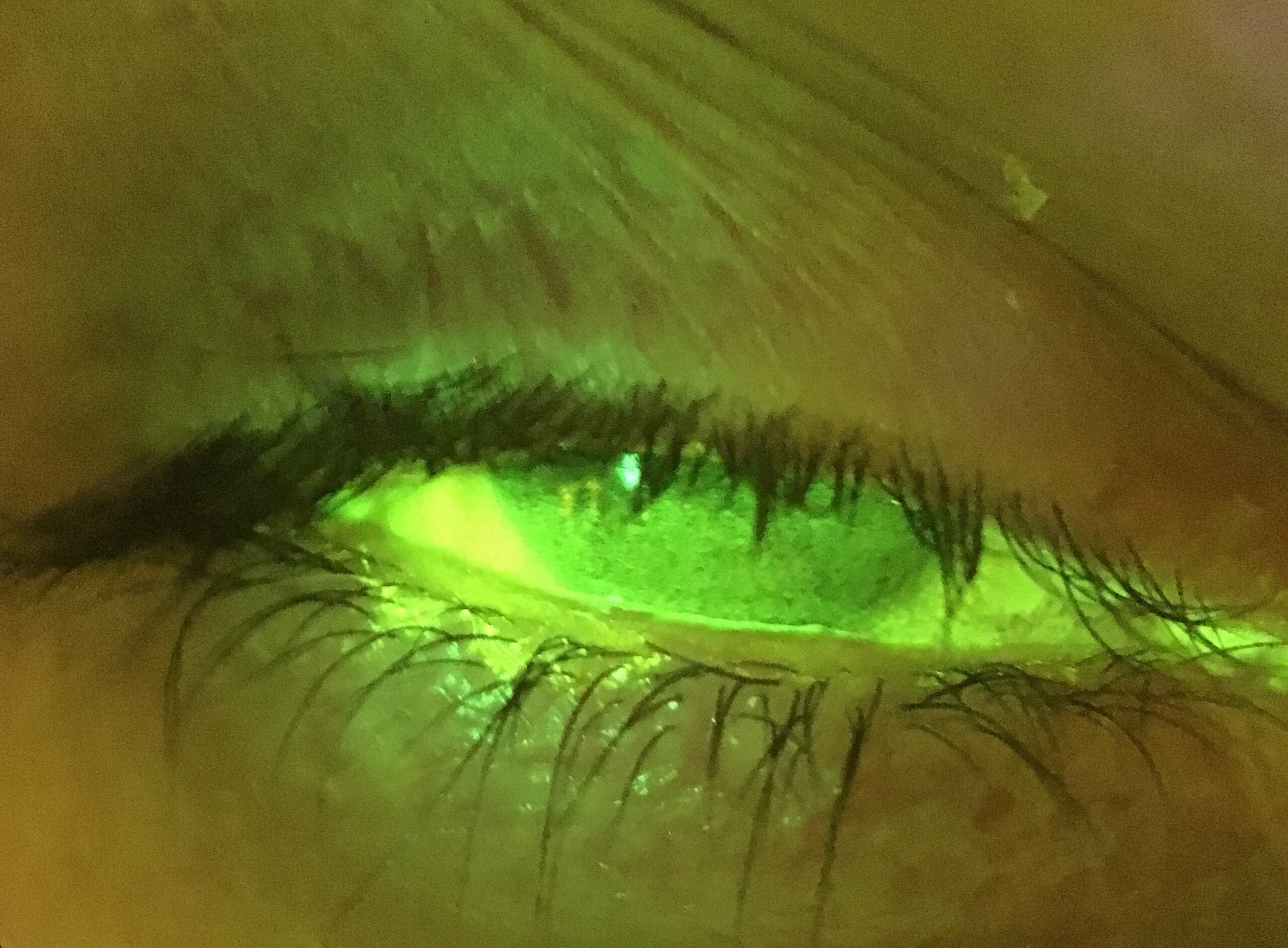 Figure 1: Severe grade 5 corneal staining and dry eye disease secondary to graft vs host disease. The patient showed extreme dry eye signs and symptoms to the extent that simply opening her eyes caused unbearable levels of pain. See Figure 2 below for the treatment outcome.