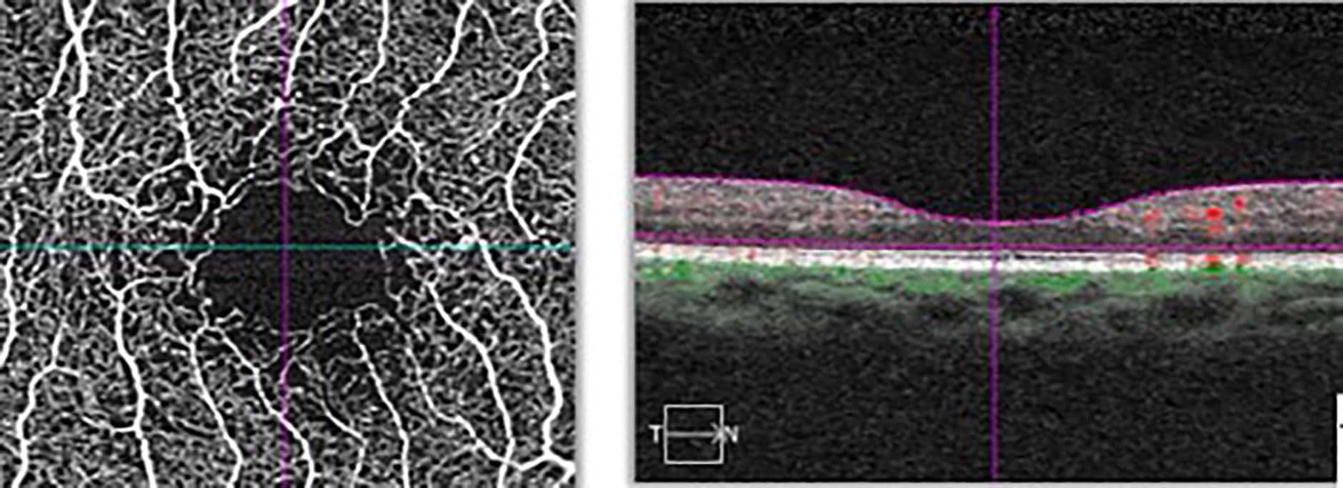 Figure 2. A 3 x 3 mm image of the macular centred on the fovea. The B scan shows the superficial capillary plexus, and deep capillary plexus. The Angio image confirms an enlarged irregular foveal avascular zone (FAZ). The widened contour of the FAZ is also evident on the B scan.