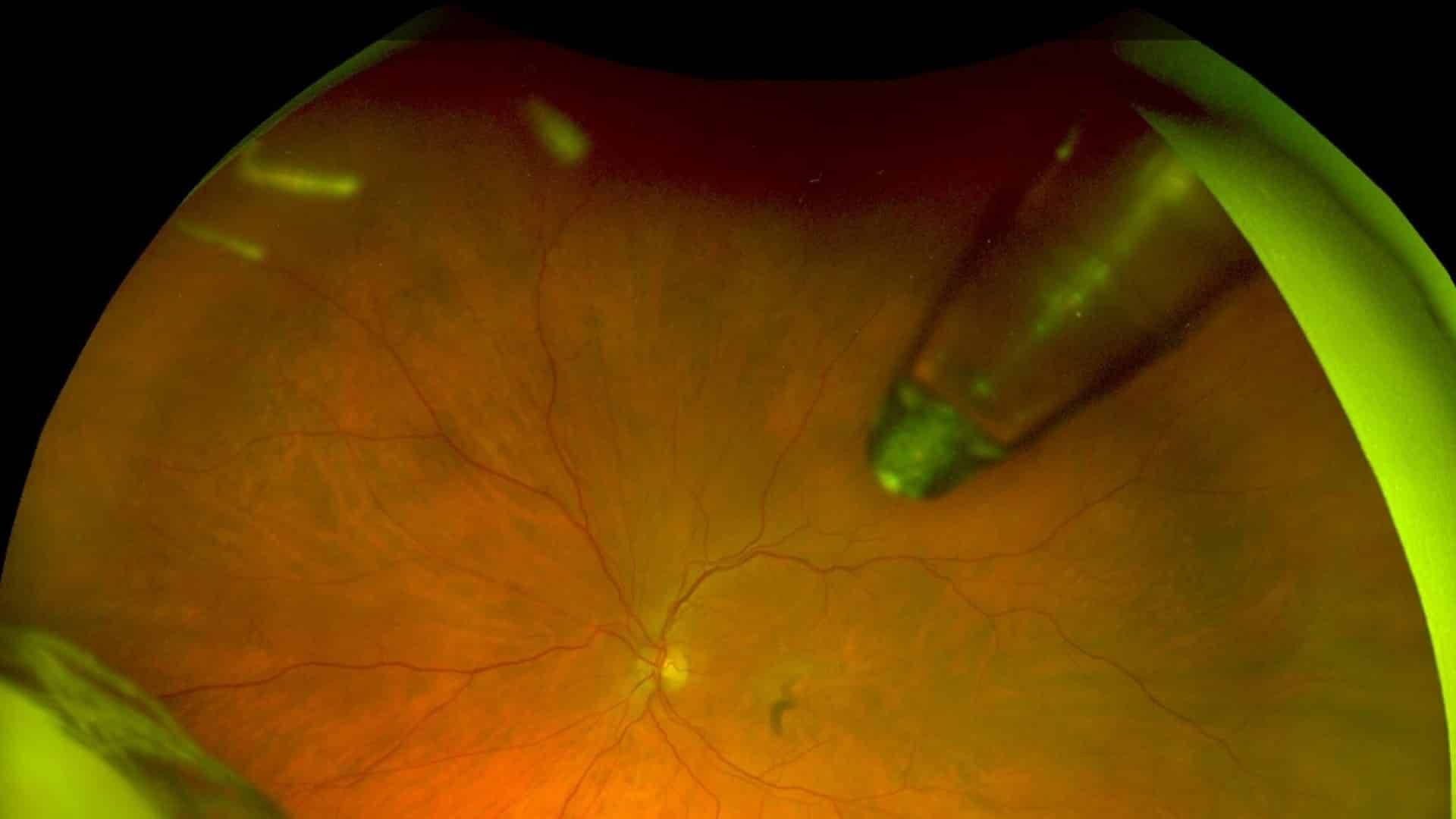 A widefield angle retinal scan showing the Port Delivery System in the eye.