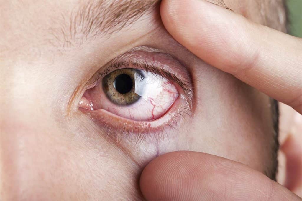Azura Ophthalmics meibomian gland dysfunction