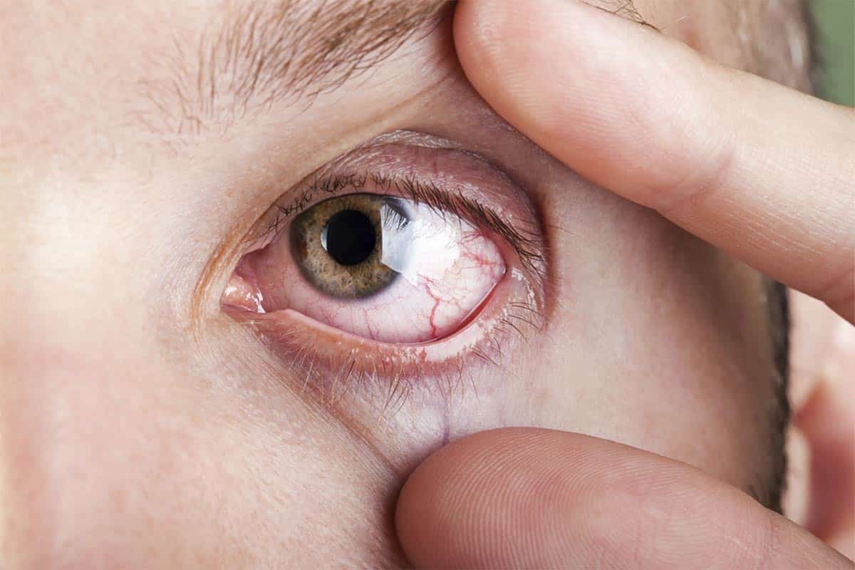Sixty-nine per cent of event attendees reported feeling worried and anxious about their dry eye. Image: Ilya Andriyanov/Shutterstock.com.