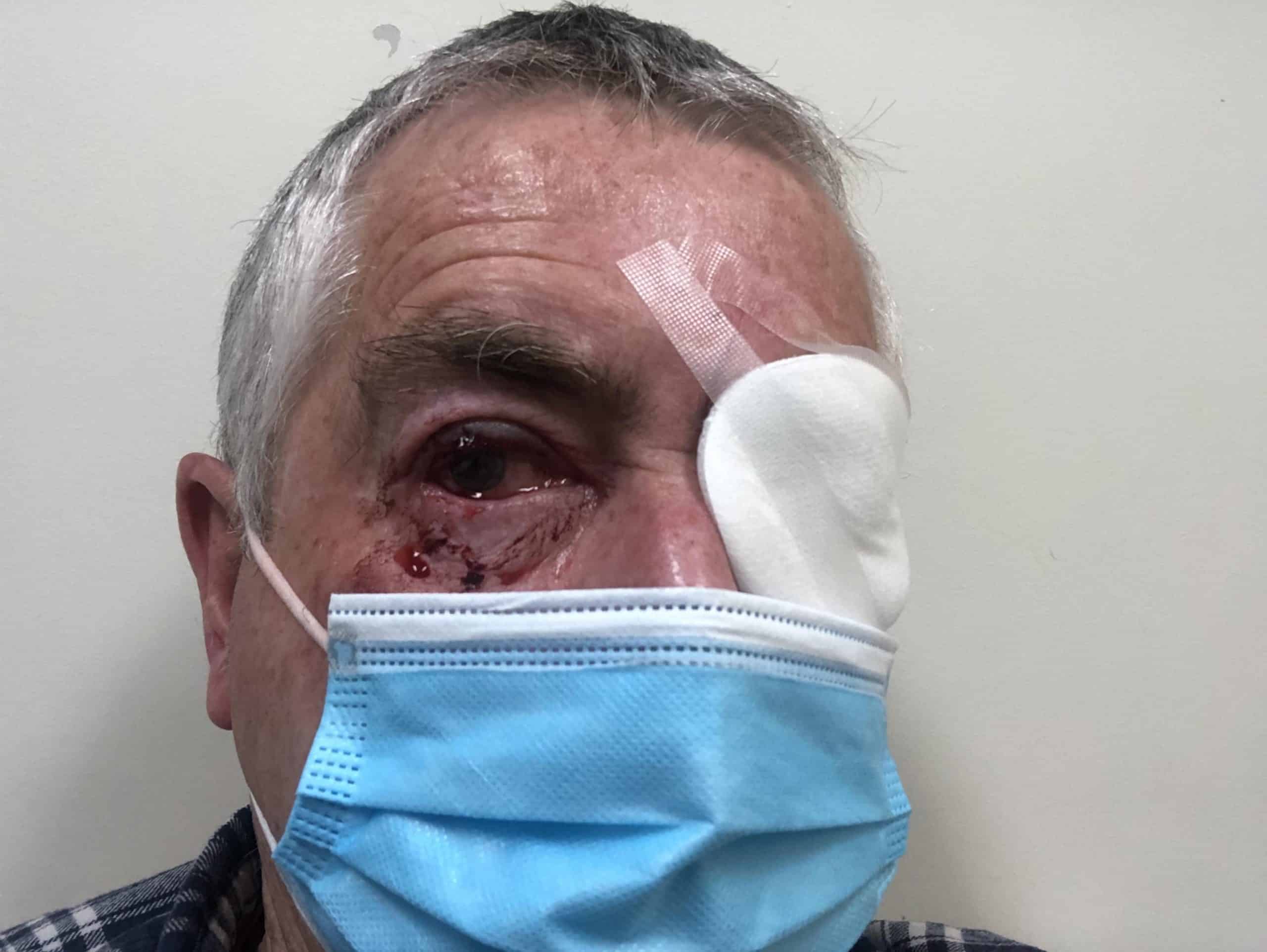 James Glindemann require a two-hour operation to repair his eye after a magpie attack.
