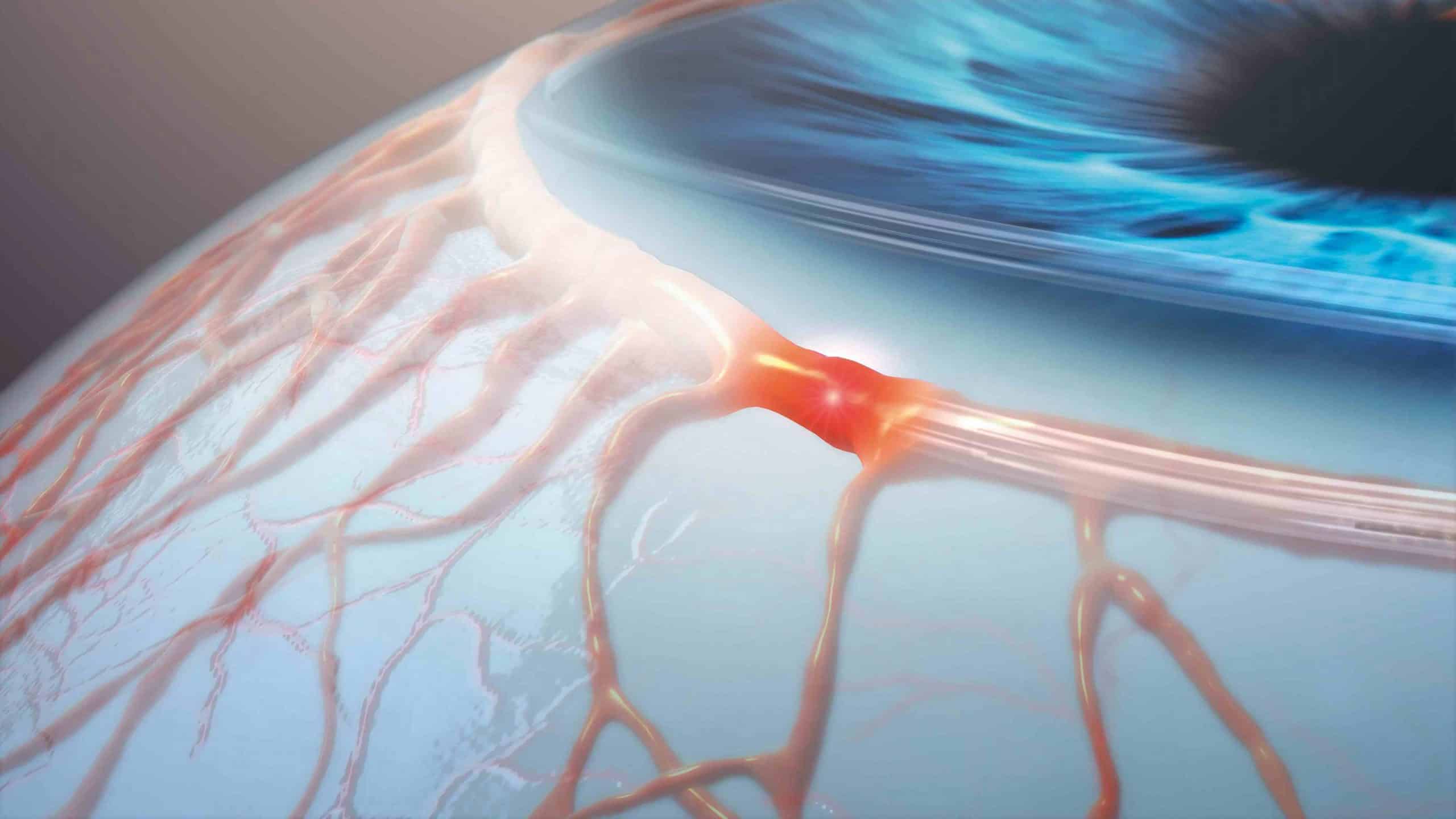 Canaloplasty targets the main sites of outflow resistance in glaucoma: the trabecular meshwork, Schlemm’s canal, and distal collector channels.