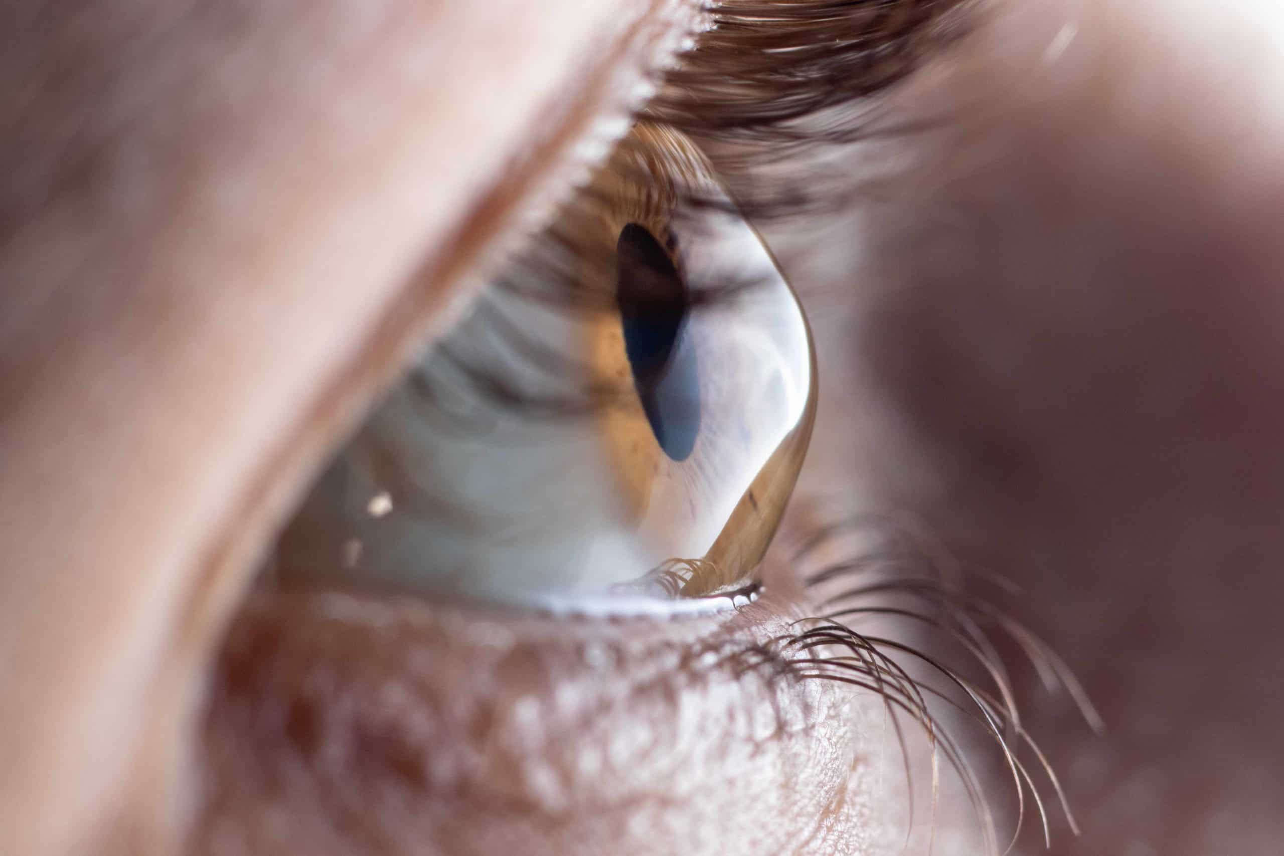 Keratoconus is a progressive disease and can advance quickly in adolescents and young adults.