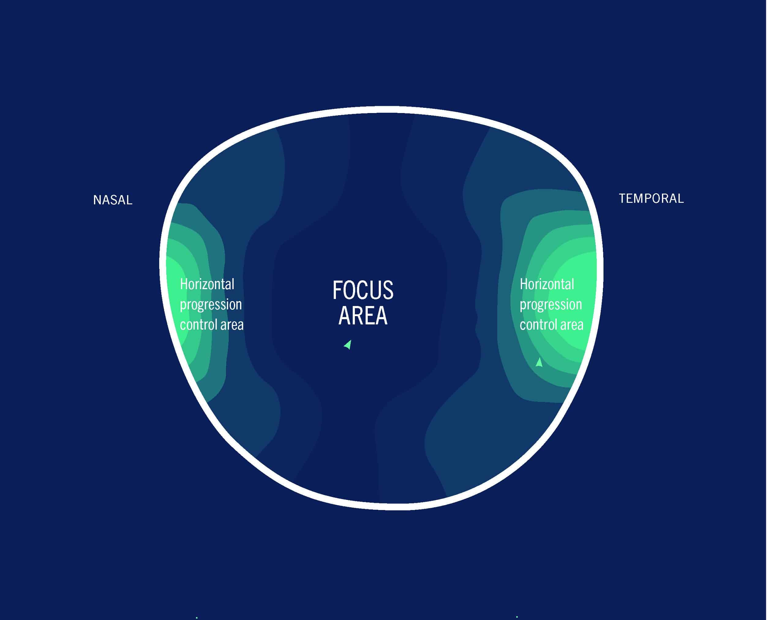 MyCon lens has three distinct zones: a central zone containing the patient’s prescription, a temporal zone of progressively increasing power up to 2.5 D, and a nasal zone of progressively increasing power up to 2.0 D.