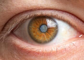 Cataract surgery