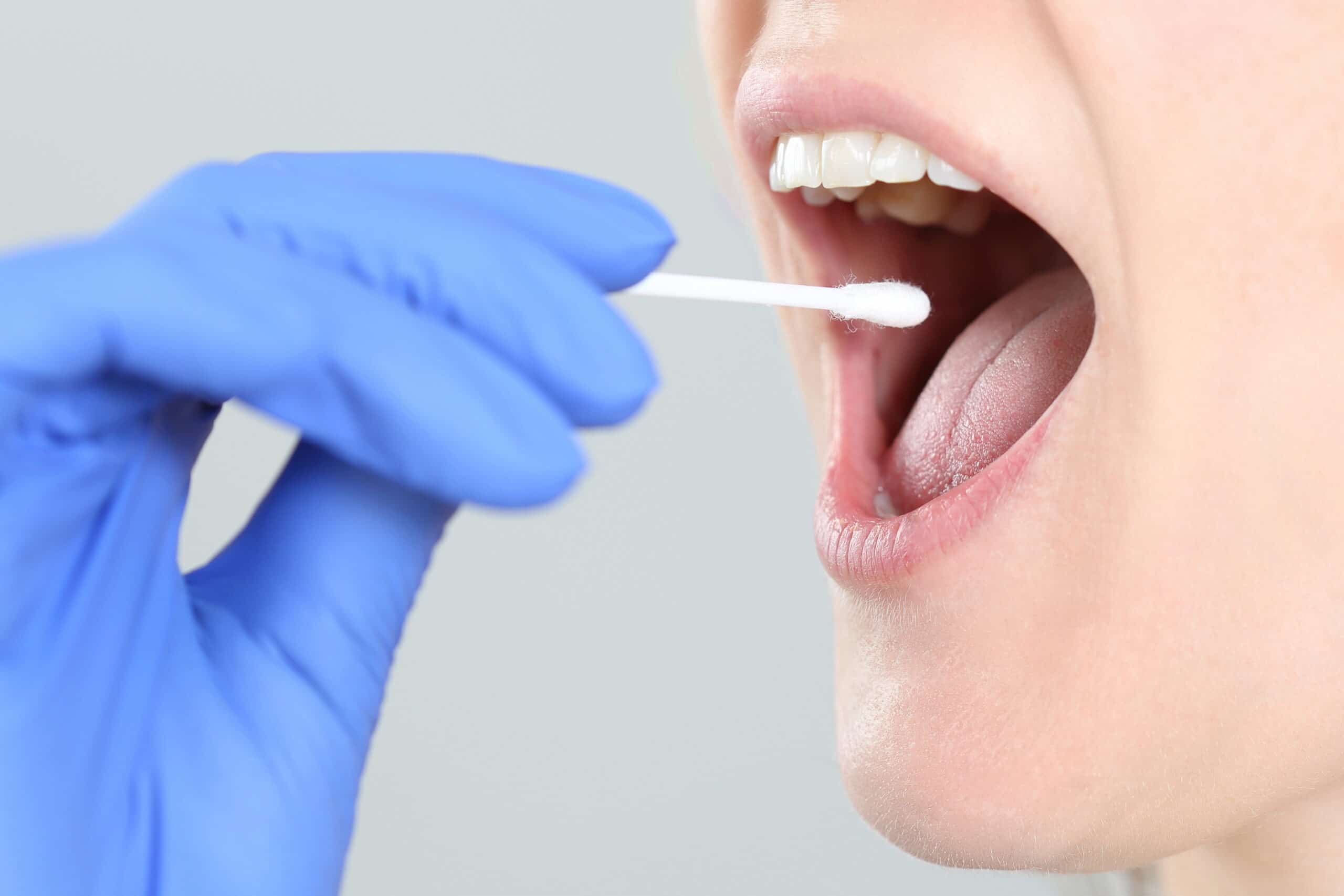 Using a blood or saliva sample, the PRS test can be used to quantify a patient’s genetic risk of glaucoma.