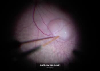 Luxturna being delivered to one of the recipients via a subretinal injection. Image: A/Prof Matthew Simunovic