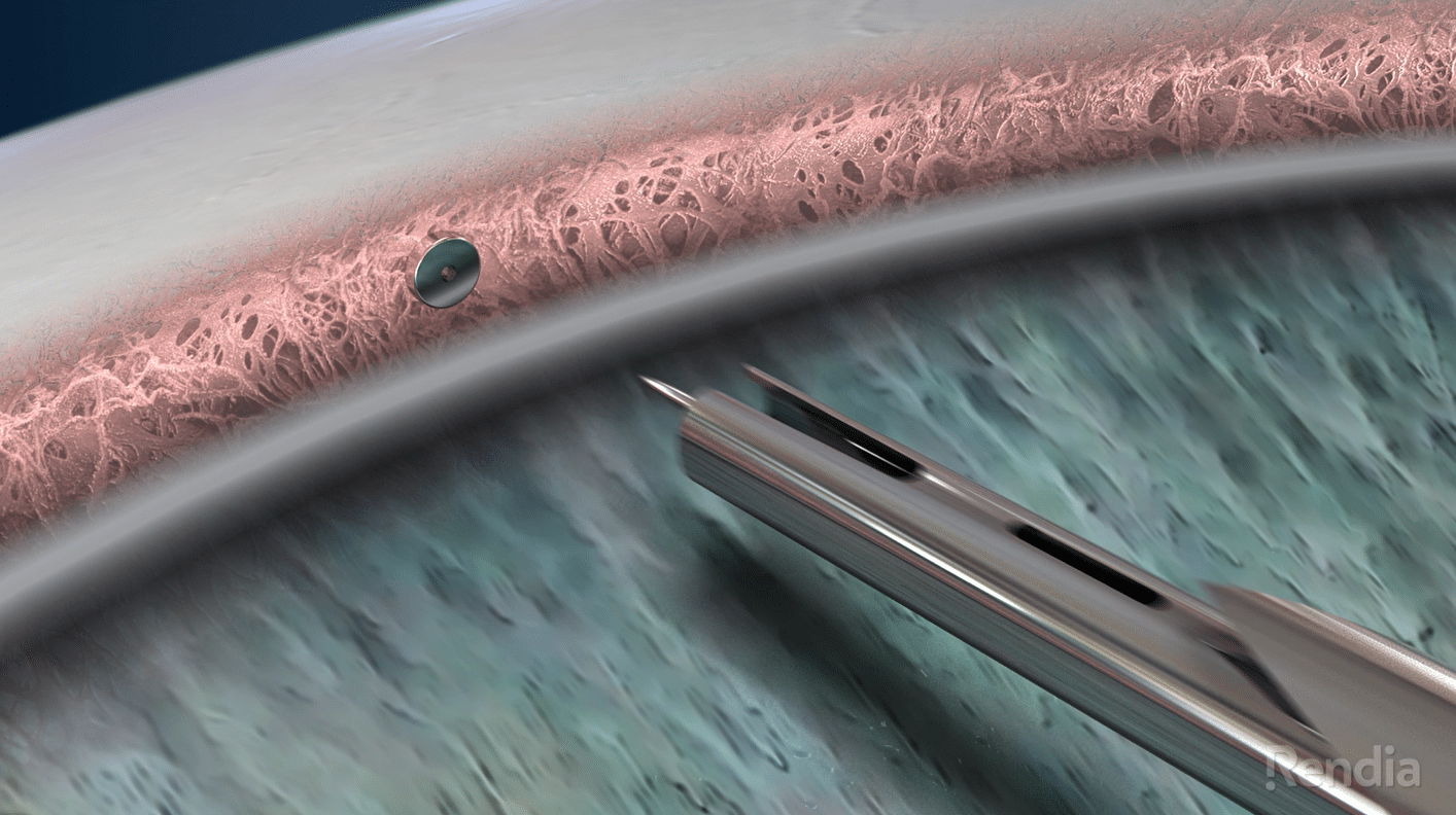 The Fight Glaucoma Blindness! Registry is tracking more than 2,500 iStent inject surgeries.