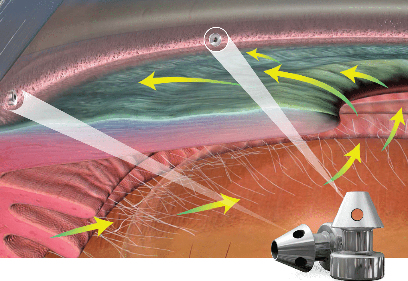 The Glaukos iStent inject Trabecular Micro-bypass System is intended to reduce IOP in adult patients diagnosed with mild to moderate open angle glaucoma.