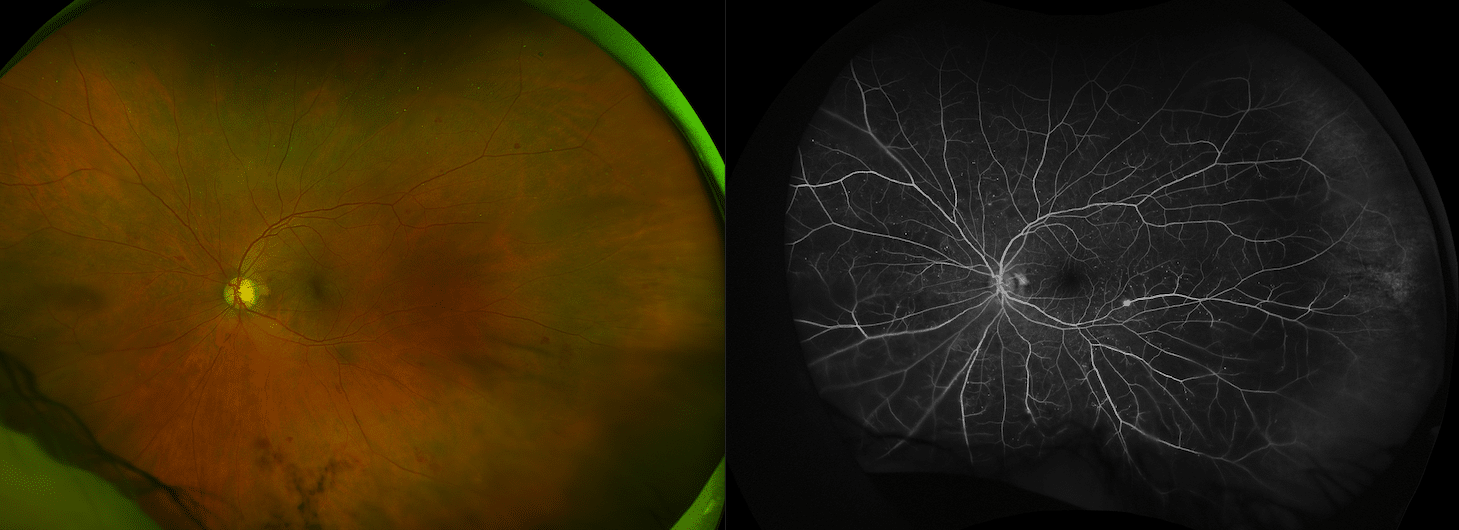 Case 1: A 47-year-old diabetic patient presents with new floaters in the left eye. Colour Optos photography (left) demonstrates inferior vitreous haemorrhage. No definite neovascularisation is visible. Optos fluorescein angiography (right) demonstrates early neovascularisation along the inferior arcade and peripheral ischaemia, consistent with development of proliferative diabetic retinopathy. The patient had subsequent pan retinal photocoagulation and is now stable with excellent central vision. Image: Dr Rajeev Chalasani