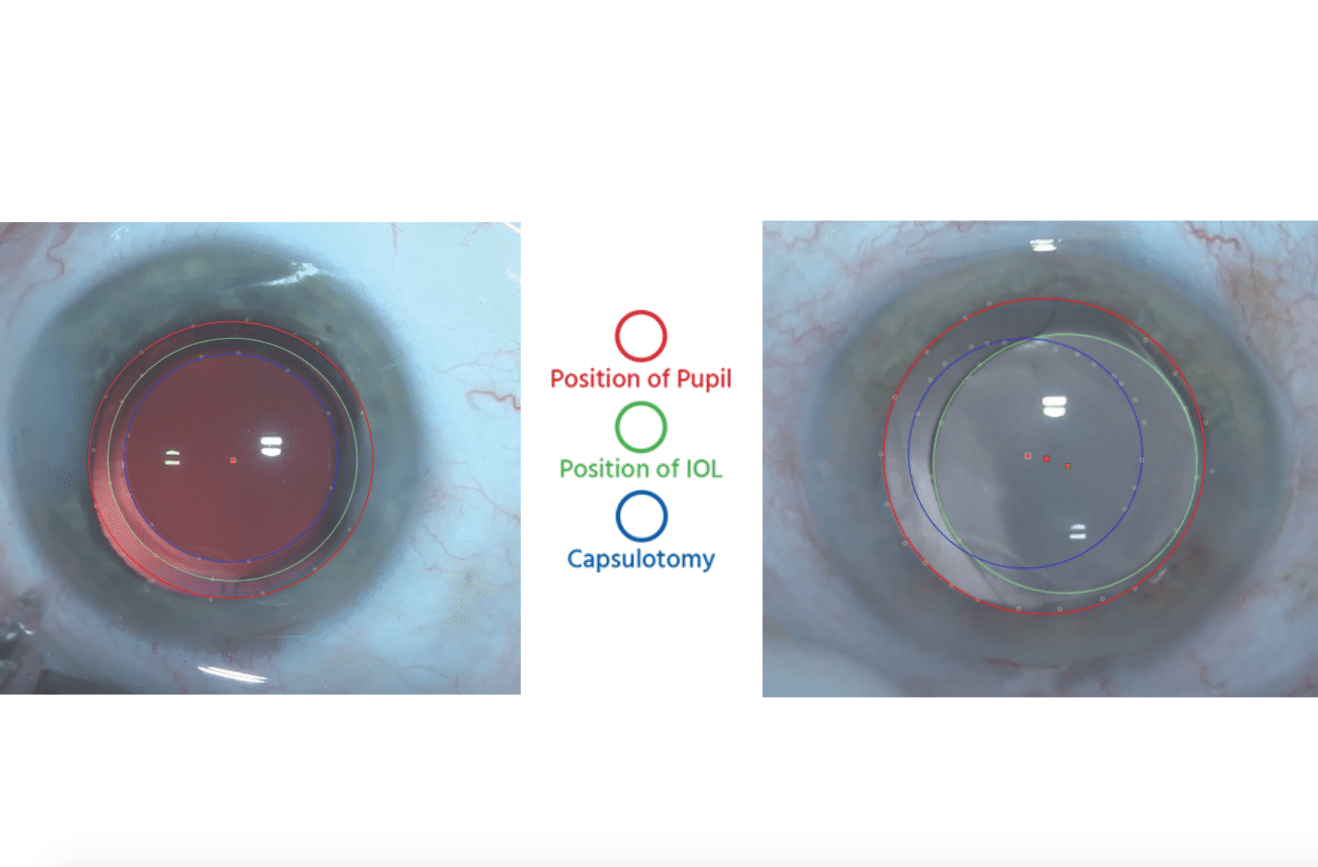 A CAPSULaser procedure on the left compared with a manual procedure on the right.