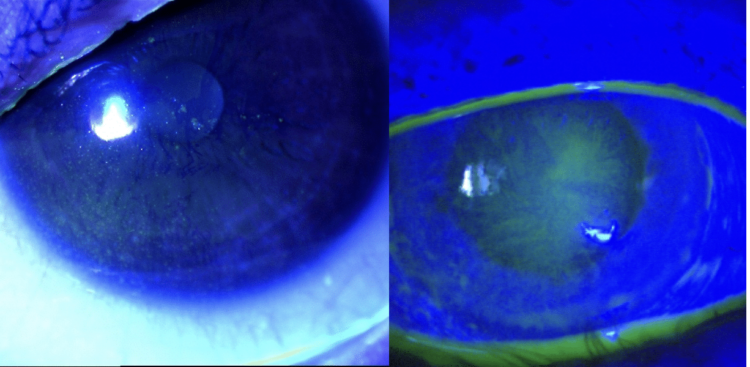 Save Sight Institute Dry Eye Registry